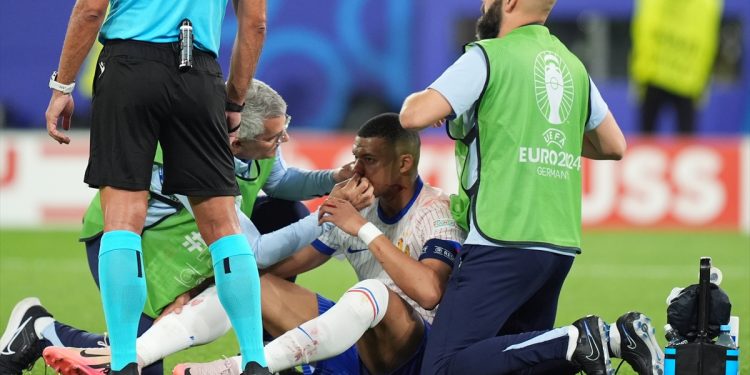 Deschamps priznao: Mbappeov nos ne izgleda nimalo dobro