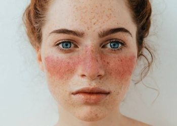 Identificiran mogući uzrok lupusa, hronične autoimune bolesti