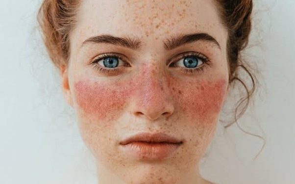 Identificiran mogući uzrok lupusa, hronične autoimune bolesti