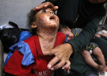 Kožne bolesti šire se među djecom u Gazi: Smeće je svuda, nema vode, ljudi žive u nemogućim uvjetima