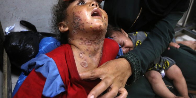 Kožne bolesti šire se među djecom u Gazi: Smeće je svuda, nema vode, ljudi žive u nemogućim uvjetima