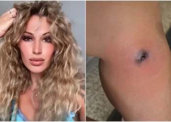 Martina zamalo umrla zbog uboda pauka: ‘Ako ovako izgleda, odmah u bolnicu!’