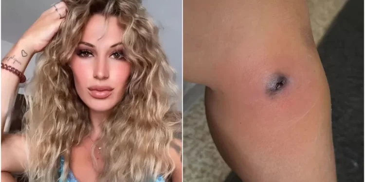 Martina zamalo umrla zbog uboda pauka: ‘Ako ovako izgleda, odmah u bolnicu!’