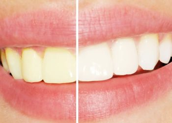 Pet stvari koje vaši zubi mogu otkriti o vašem zdravlju