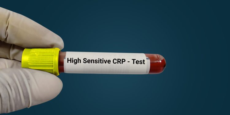 Povišen vam je CRP? Šta znače određene vrijednosti kod djece i kod odraslih