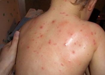 U proteklih sedam dana dva nova slučaja zaraze morbilima u ZDK, oba u Visokom