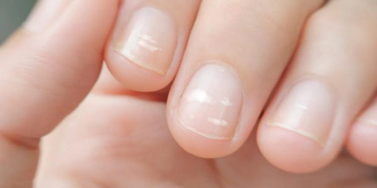 Neočekivani znakovi starenja pojavljuju se na noktima